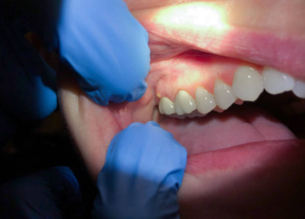 Best Emergency Dental Care for Broken or Chipped Teeth in Sacred Heart University, CT